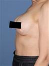 Breast Augmentation - Estethica外科医疗中心