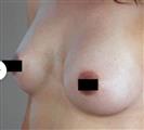 Breast Augmentation - Estethica外科医疗中心