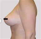 Breast Lift - Estethica外科医疗中心