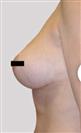 Breast Reduction - Estethica外科医疗中心