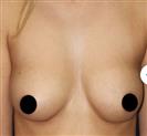 Breast Reduction - Estethica外科医疗中心