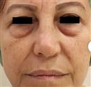 Eyelid Aesthetics (Blepharoplasty) - Estethica外科医疗中心