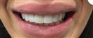 Teeth Whitening - Estethica外科医疗中心