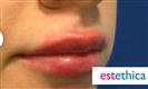 Lip Enhancement (Lip Augmentation) - Estethica外科医疗中心