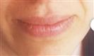 Lip Enhancement (Lip Augmentation) - Estethica外科医疗中心