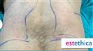 Liposuction (Abdominal) - Estethica外科医疗中心