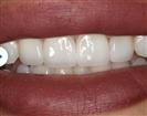Teeth Cleaning - Estethica外科医疗中心