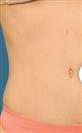 Tummy Tuck (Abdominoplasty) - Estethica外科医疗中心