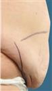Tummy Tuck (Abdominoplasty) - Estethica外科医疗中心