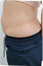 Abdominoplasty (Tummy Tuck) - Estethica外科医疗中心