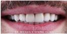 Dental Veneers - Dr. Michael’s Dental Clinics