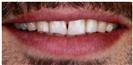 Dental Veneers - Dr. Michael’s Dental Clinics