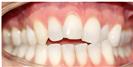 Dental Braces - Dr. Michael’s Dental Clinics