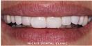 Dental Veneers - Micris Dental Clinics