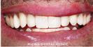 Dental Fillings - Micris Dental Clinics