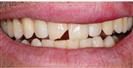 Dental Fillings - Micris Dental Clinics