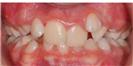 Dental Braces - Micris Dental Clinics