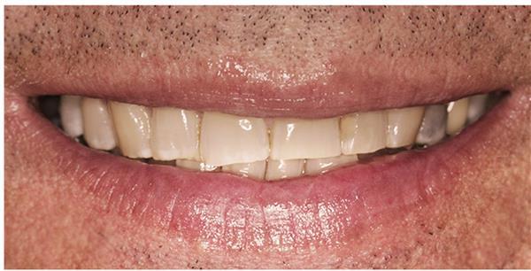 Dental Veneers