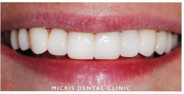 Dental Veneers