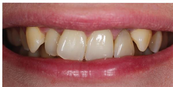 Dental Veneers